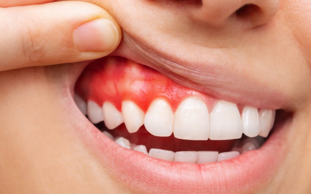 Can Gum Disease Be Reversed?