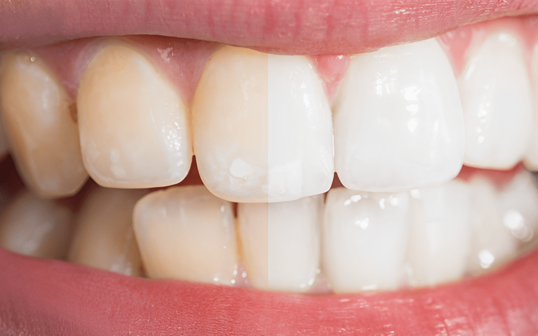 4 Easy Steps To The Secret Smile Makeover