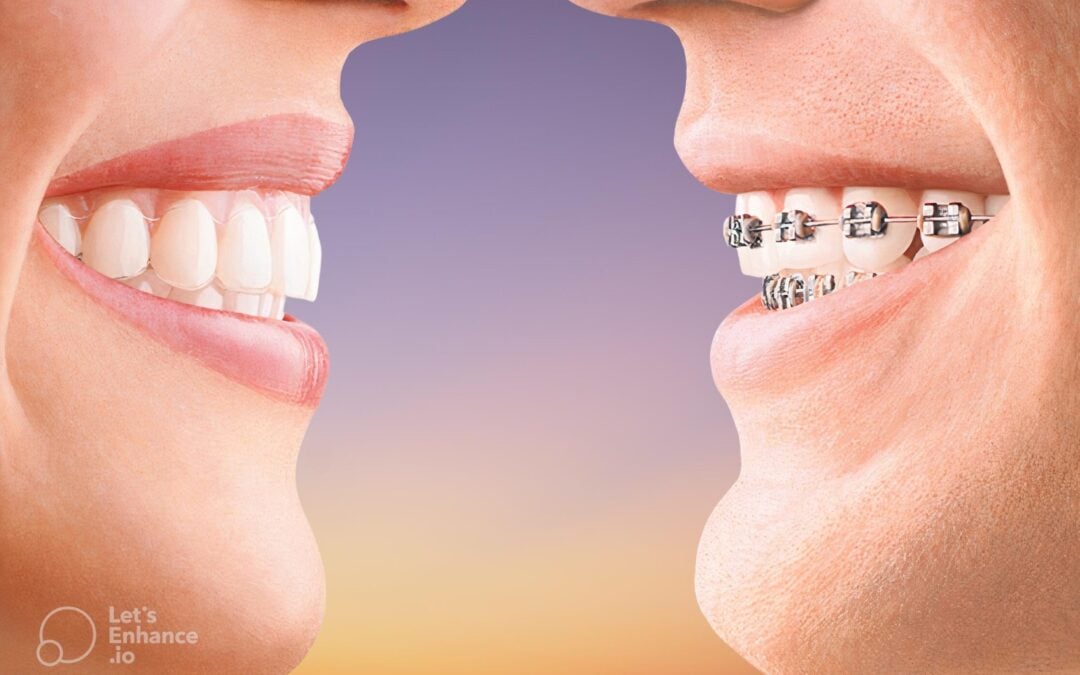 4 Things to Know About Invisalign Retainers