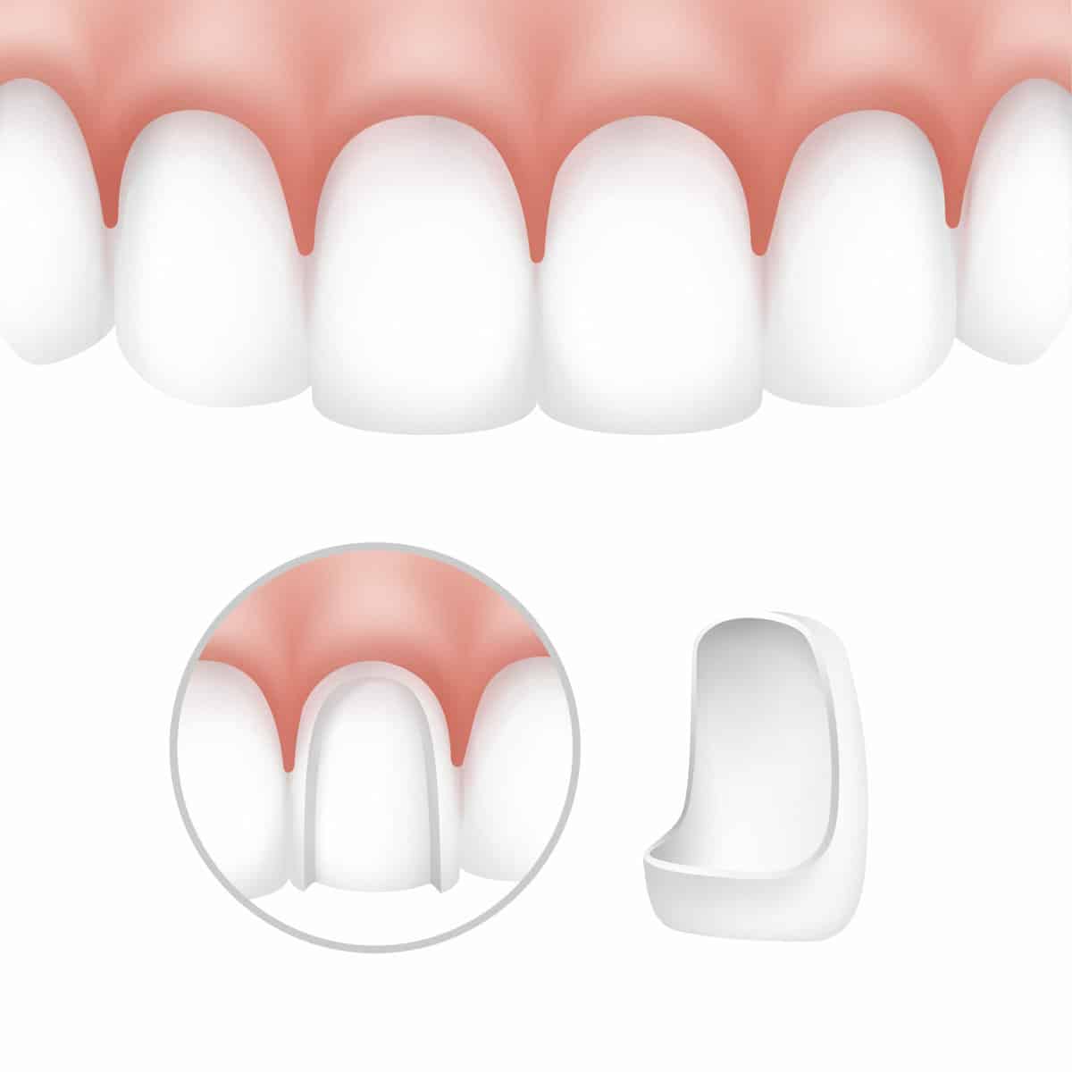 Dental veneers on human teeth