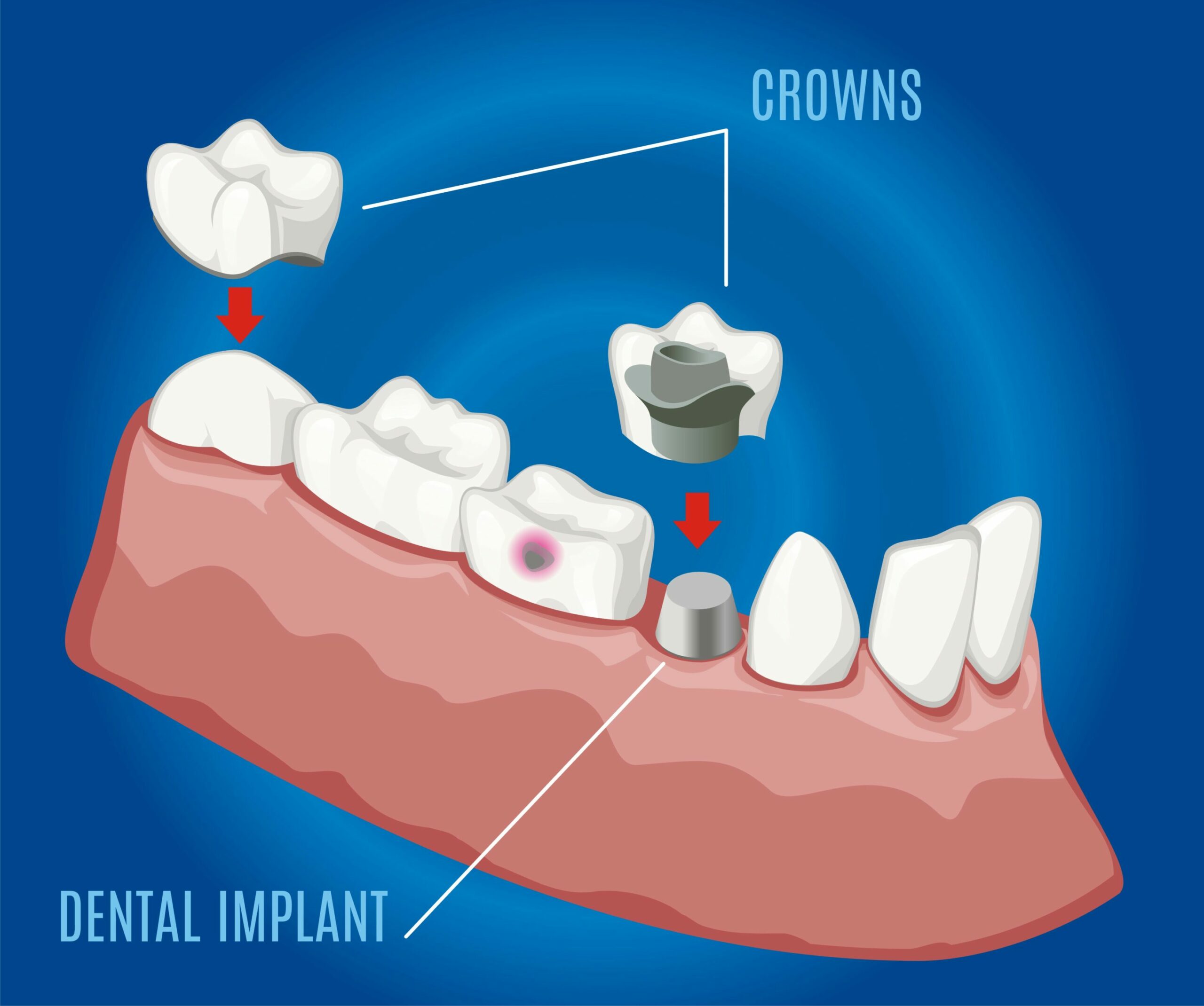 dental crown image