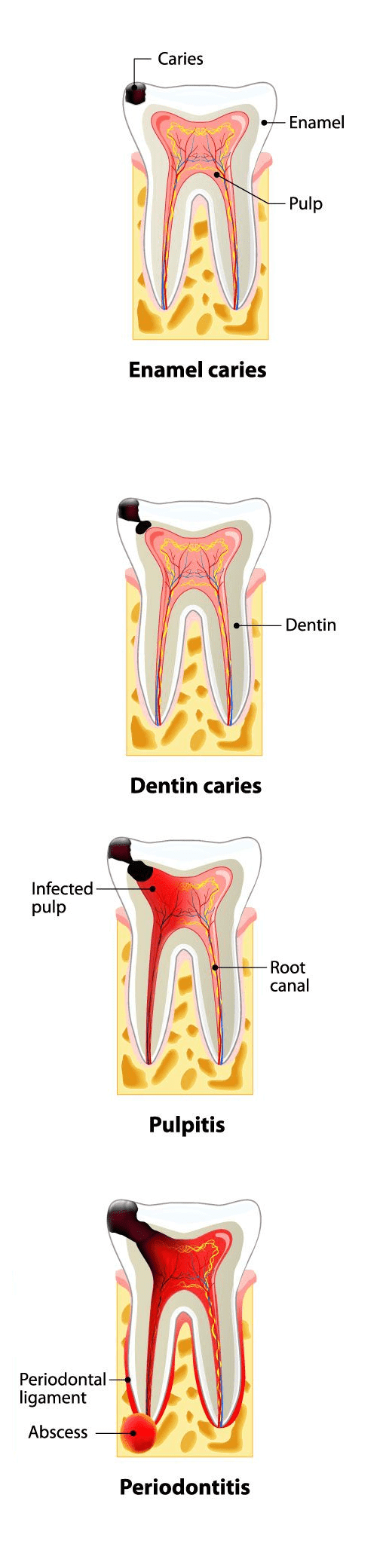stages of cavities vertical