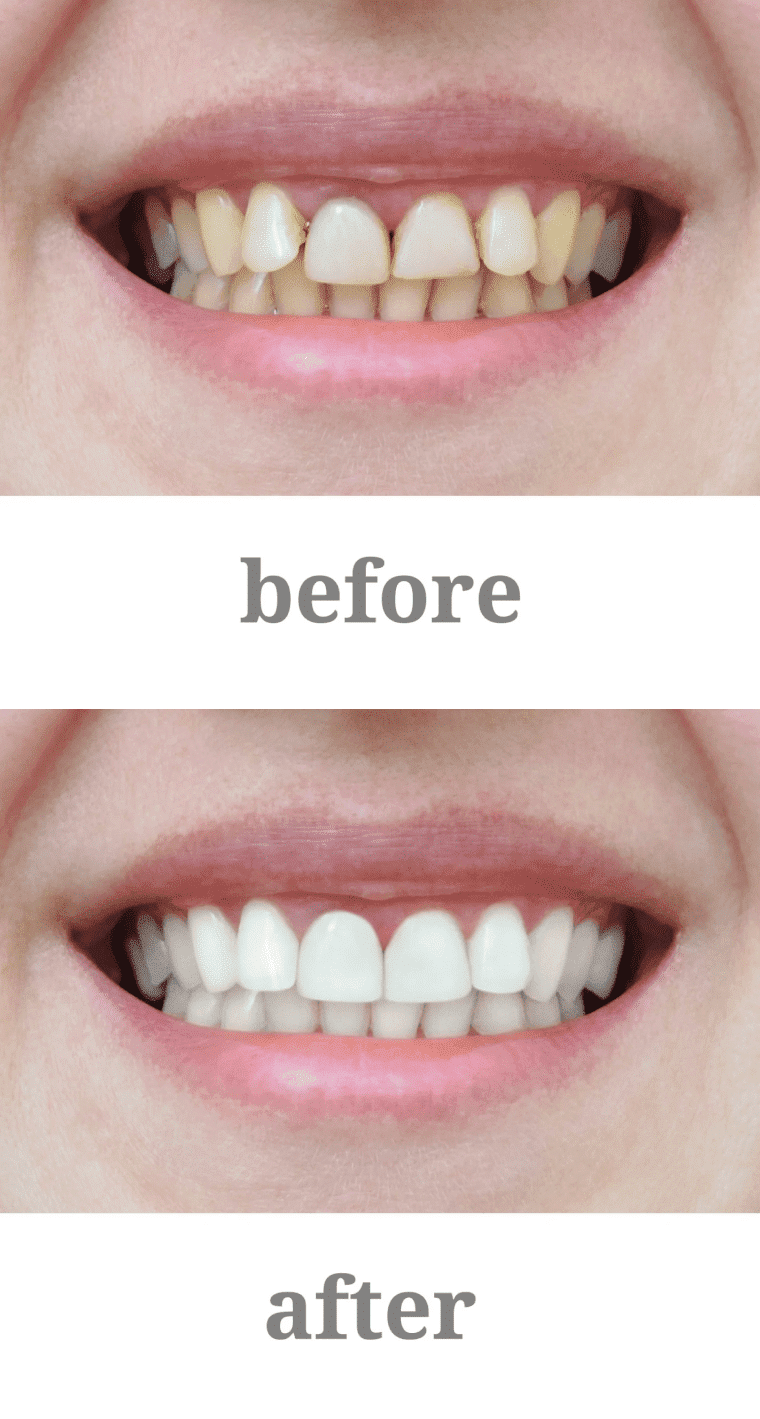 full mouth reconstruction before and after