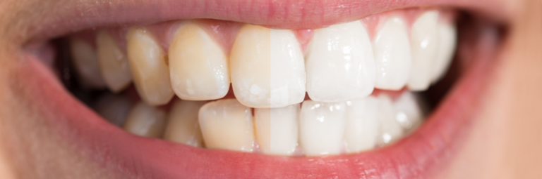 Dental Services 68 Teeth Whitening in South San Francisco