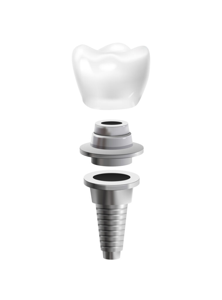 What Is a Dental Crown? 7 Things Patients Actually Want to Know