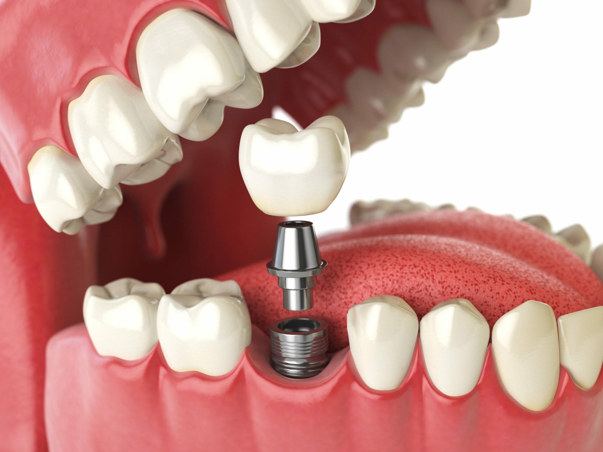 Tooth dental implant. Dental concept.