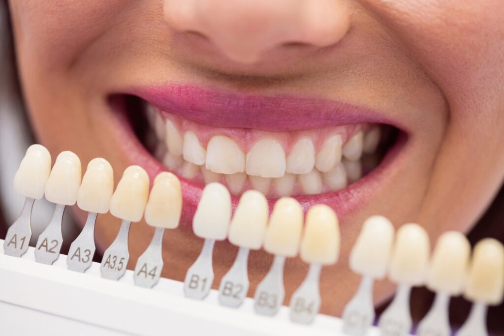 Veneers vs. Crowns: Which Is Right for You? 1 Comparison of a porcelain veneer and a dental crown at a South San Francisco dentist