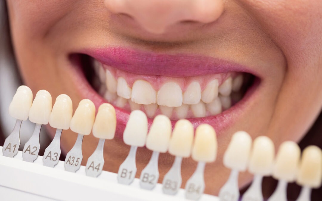 Veneers vs. Crowns: Which Is Right for You?