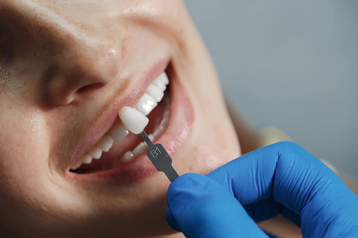 dentist-teeth veneers color