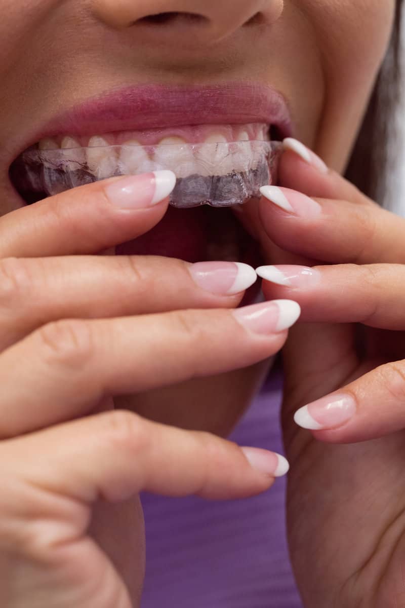 Close-up of female patient wearing clear braces in dental clinic