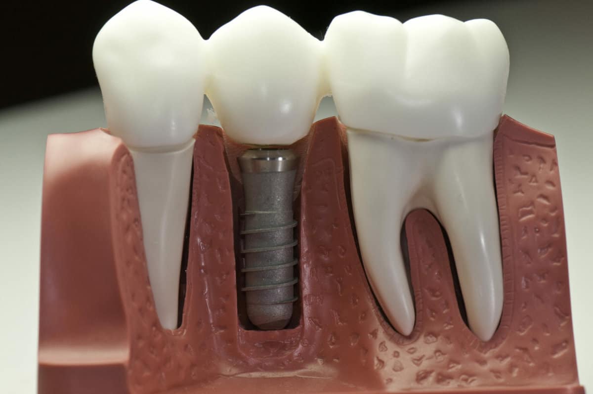 Capped Dental Implant Model