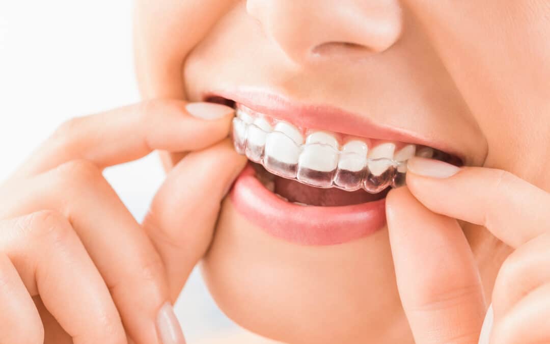4 Things to Know About Invisalign in South San Francisco