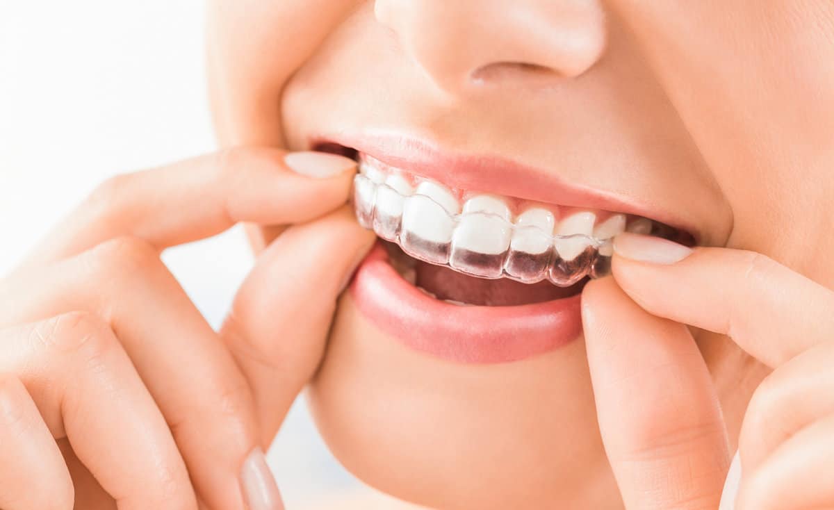 Beautiful smile and white teeth with invisalign