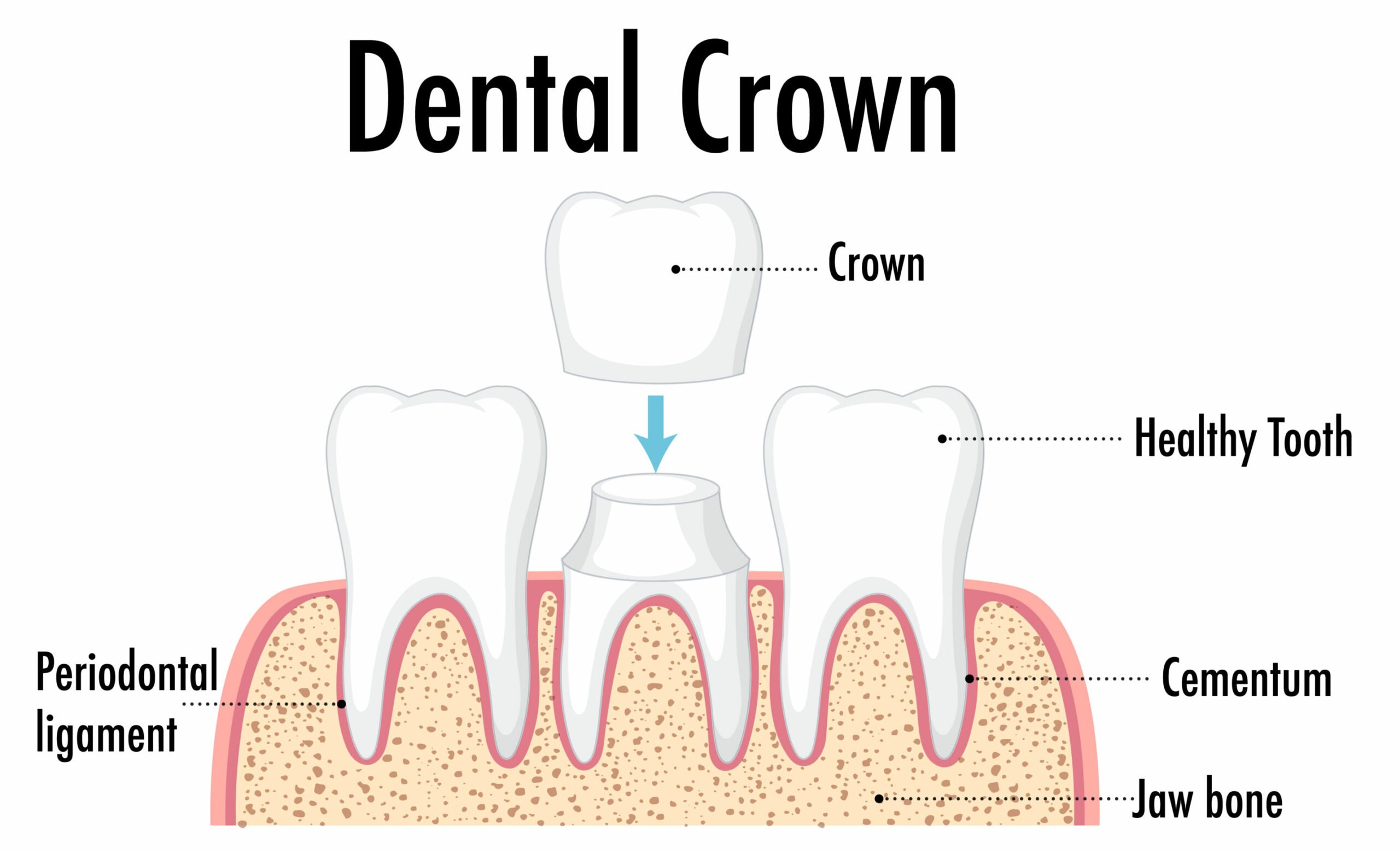 dental crown infographic