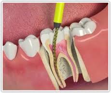 Root Canal Root Canal