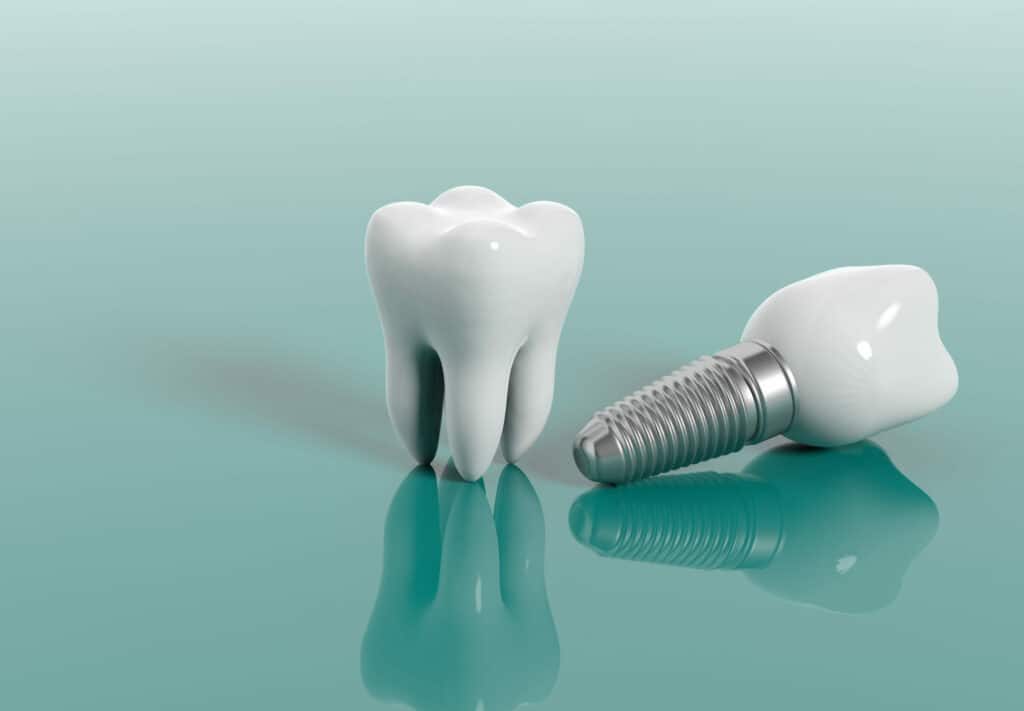 How Much Do Dental Implants Cost? (2026 Guide) 1 Dental implant model showing post, abutment, and crown at a South San Francisco dentist