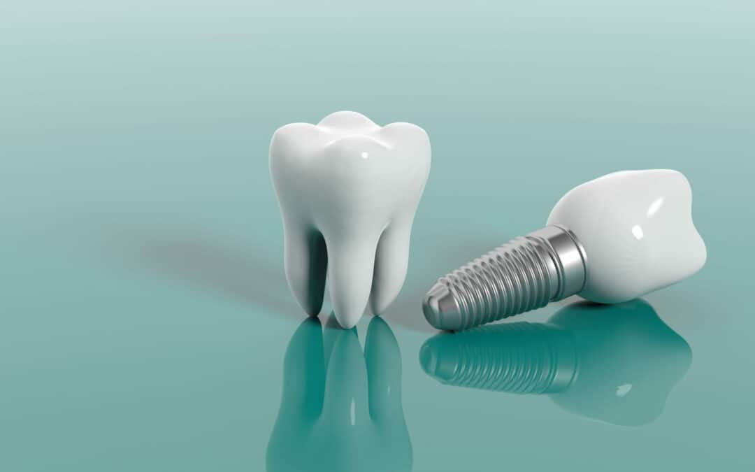 How Much Do Dental Implants Cost? (2026 Guide)