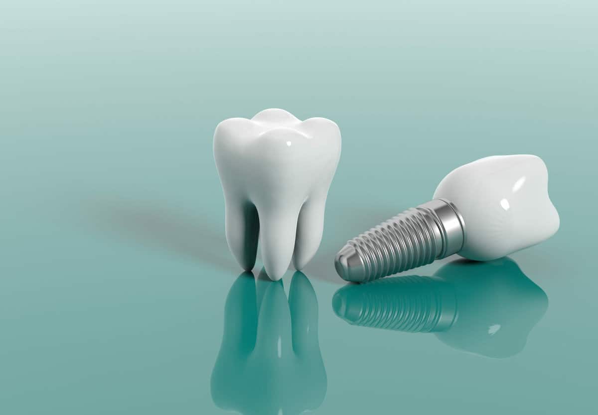 Teeth implant isolated on green background. 3d illustration