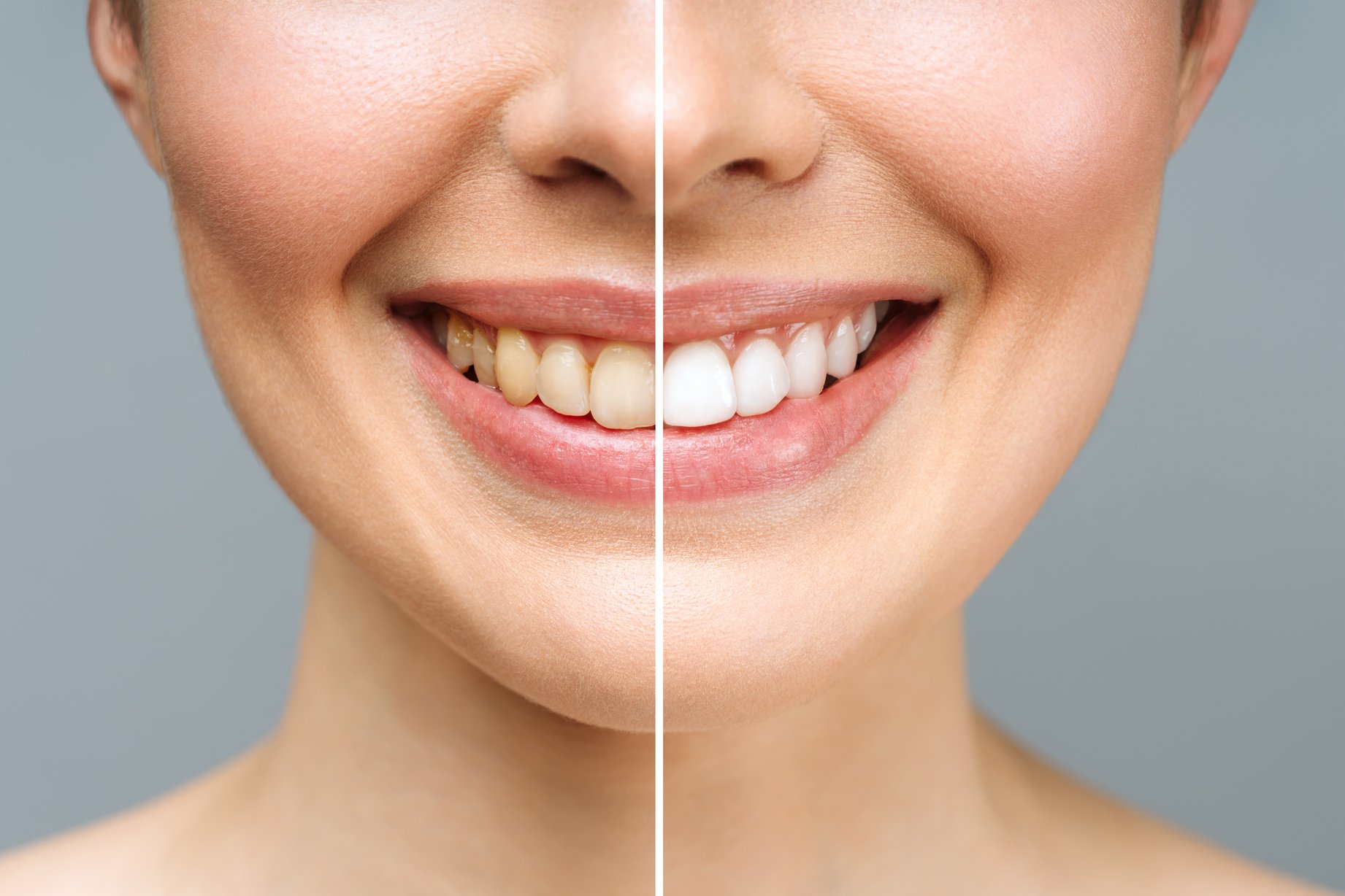 teeth whitening before and after south san francisco