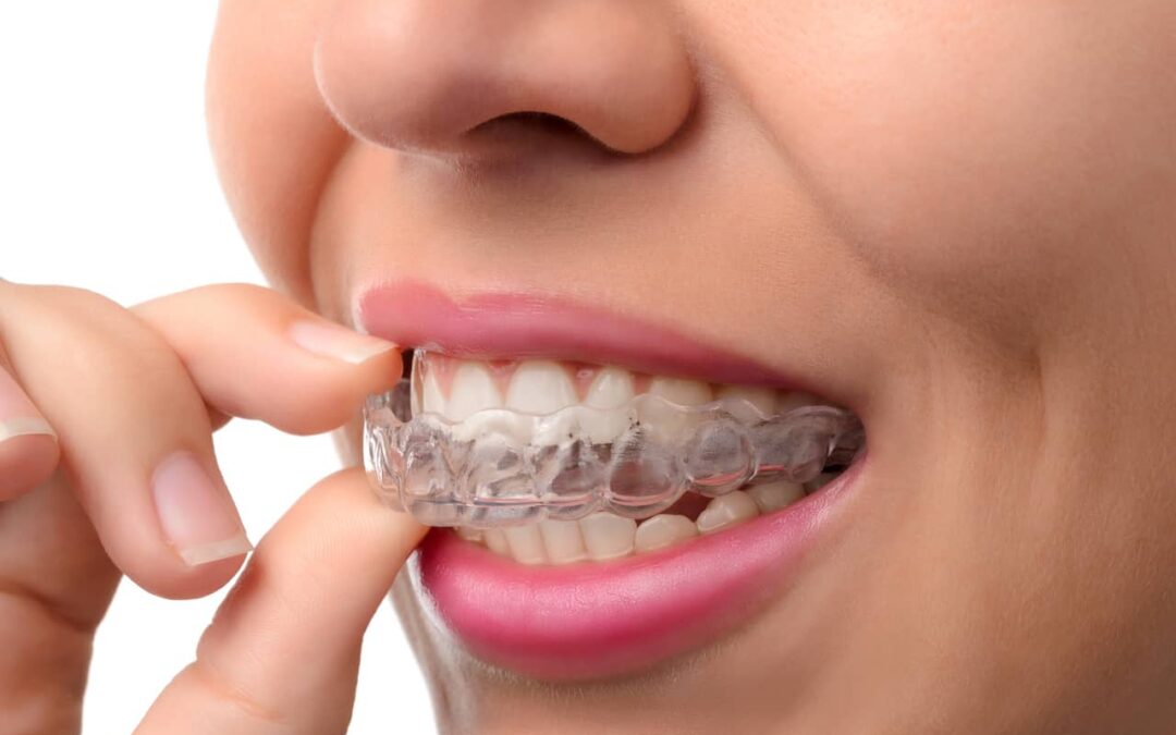 What You Should Know Before You Get Retainers