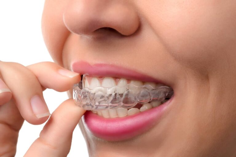 Dental Services 89 Invisalign in South San Francisco