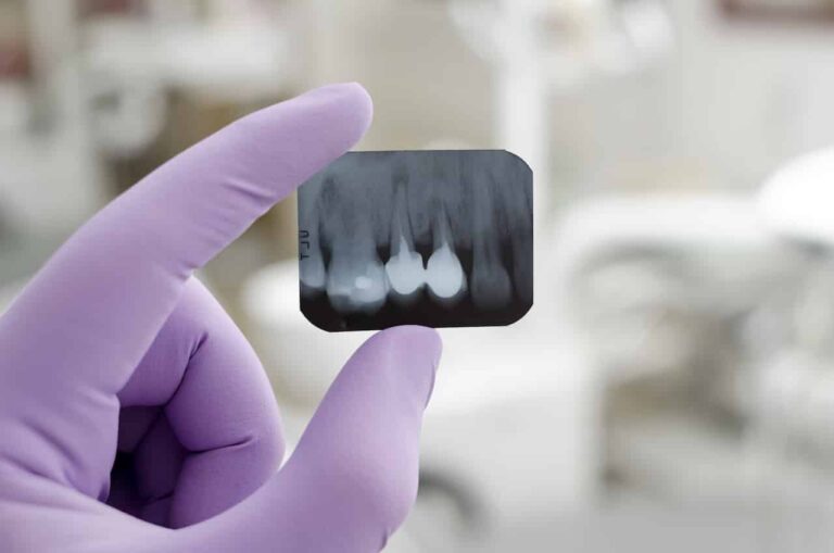 Dental Services 61 Cavities in South San Francisco
