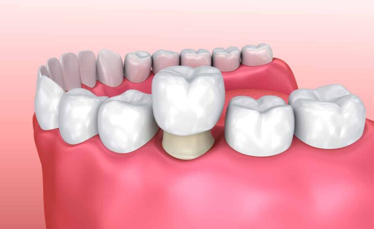 Dental Services 74 Dental Crowns in South San Francisco