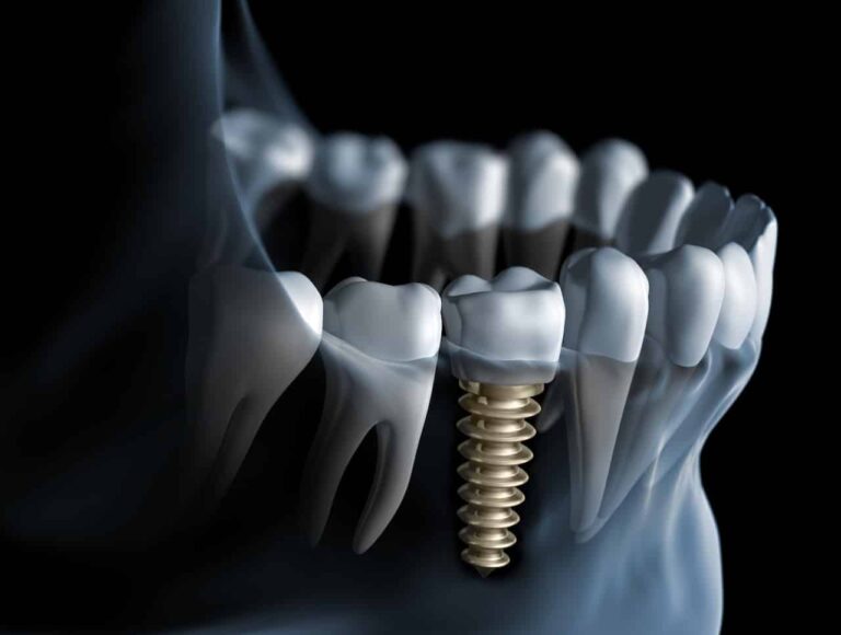 Dental Services 85 Dental Implants in South San Francisco