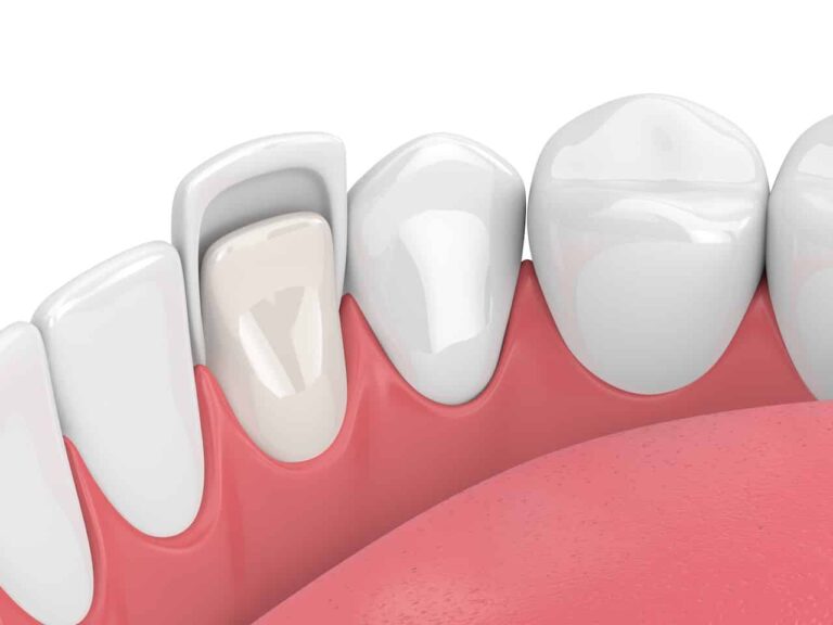 Dental Services 66 Dental Veneers in South San Francisco