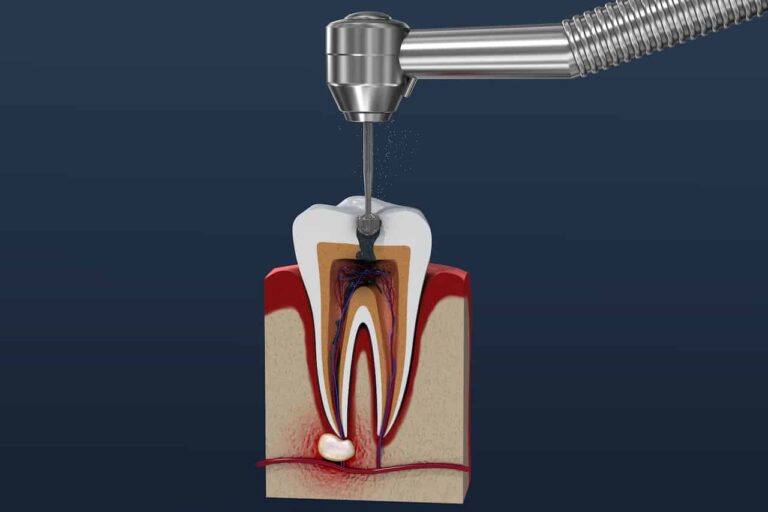 Dental Services 93 Root Canal in South San Francisco