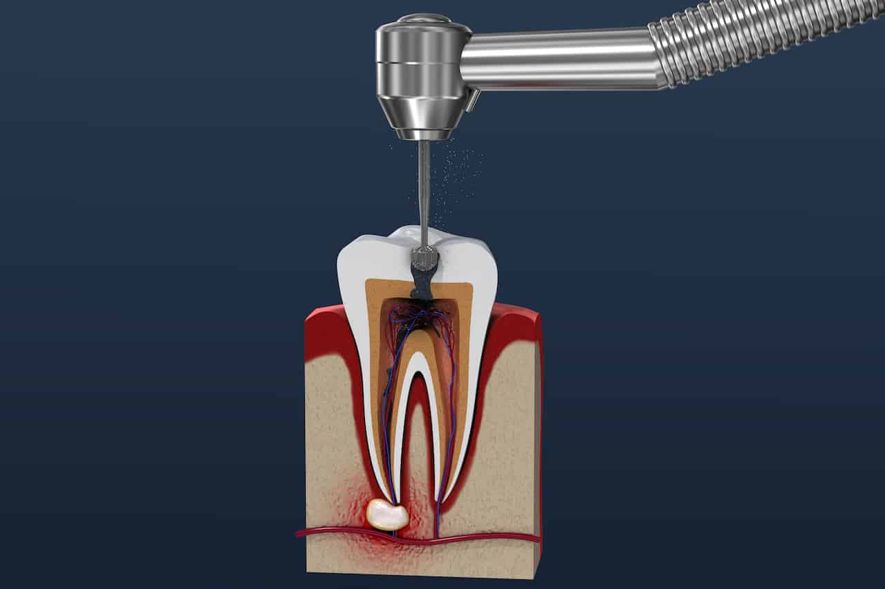 Root Canal Root Canal