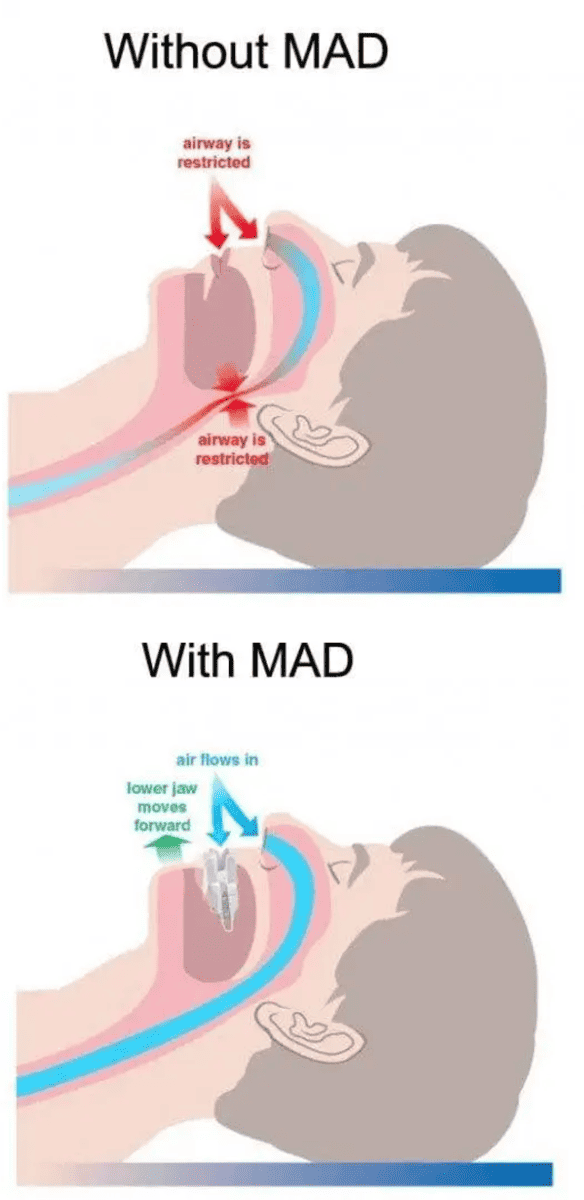 MAD sleep apnea and snoring dentist