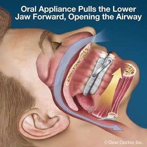 appliance sleep apnea and snoring dentist