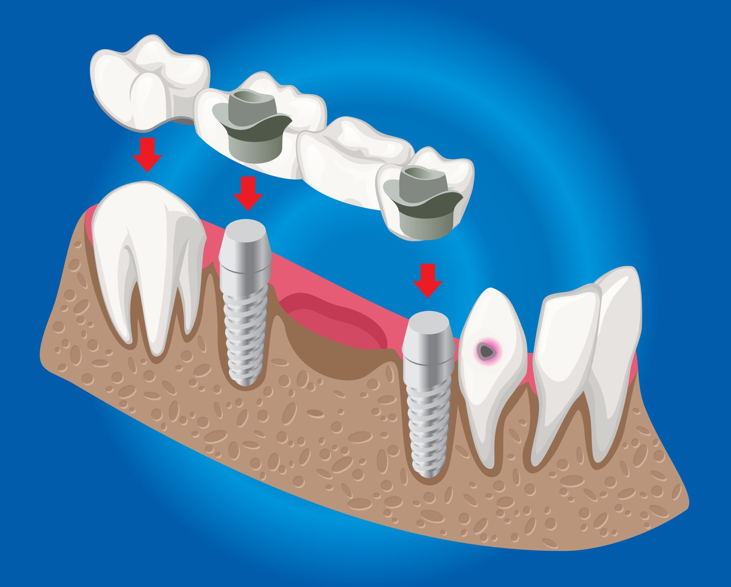 Dental bridges image