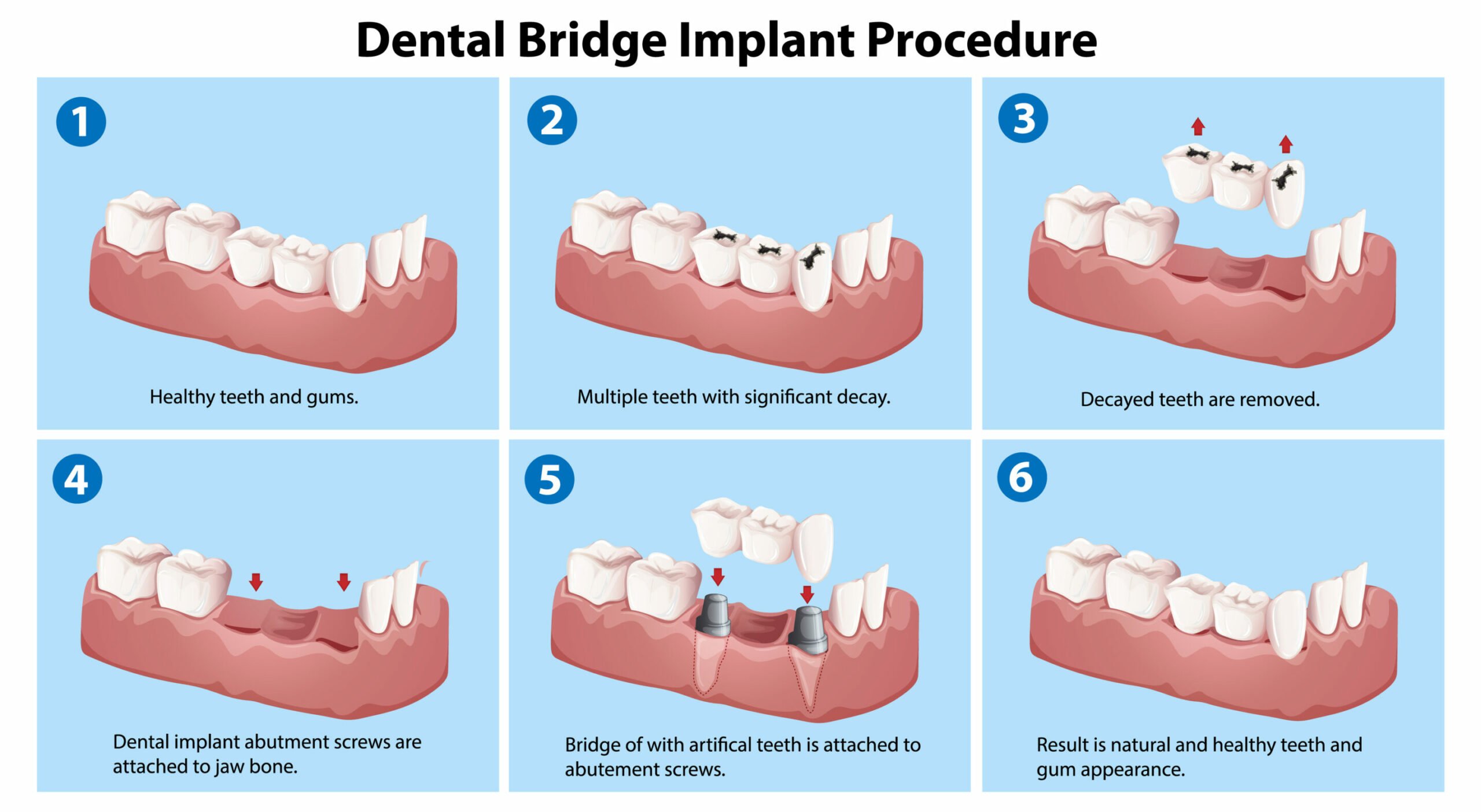 Dental bridges procedure