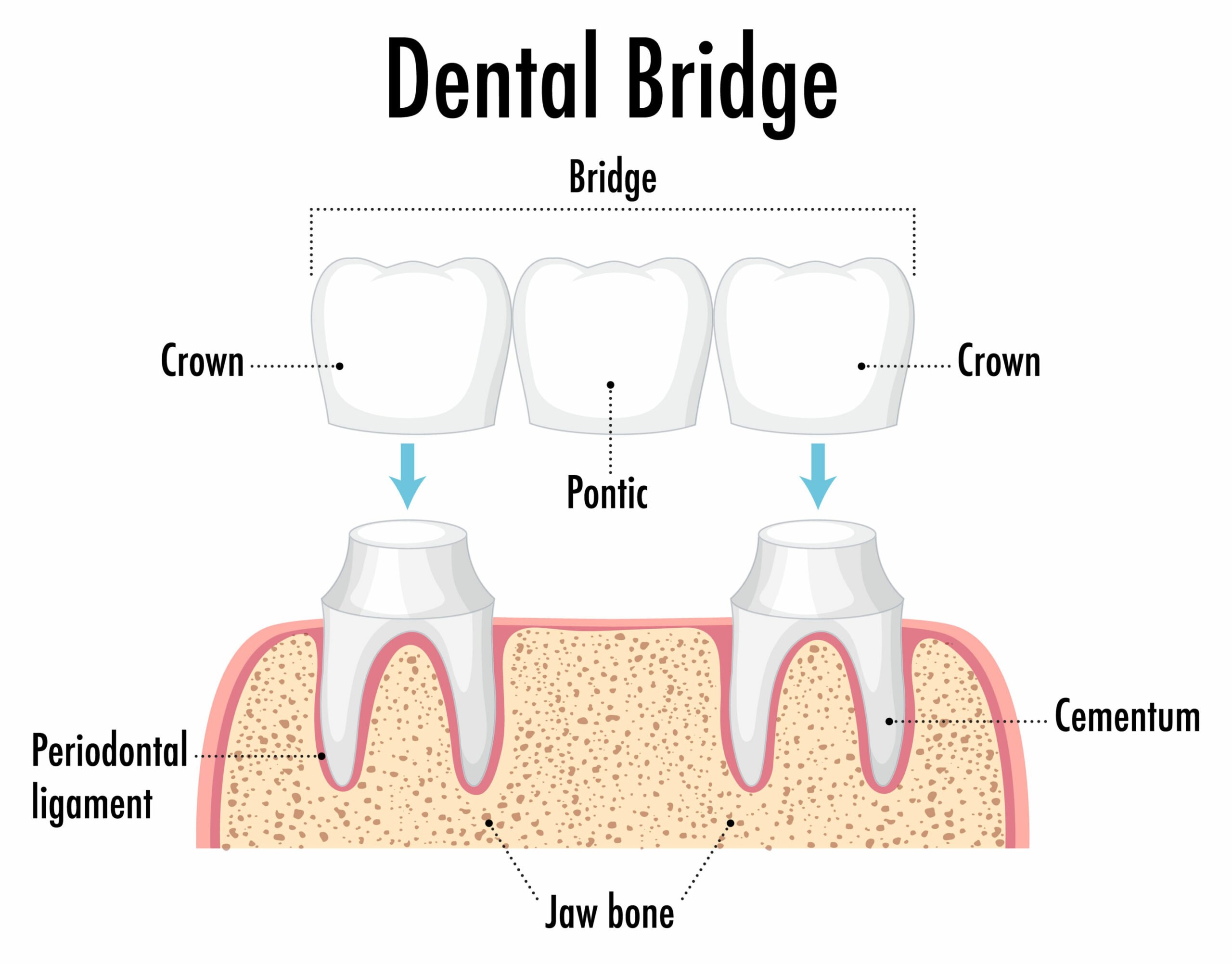 dental bridge infographic