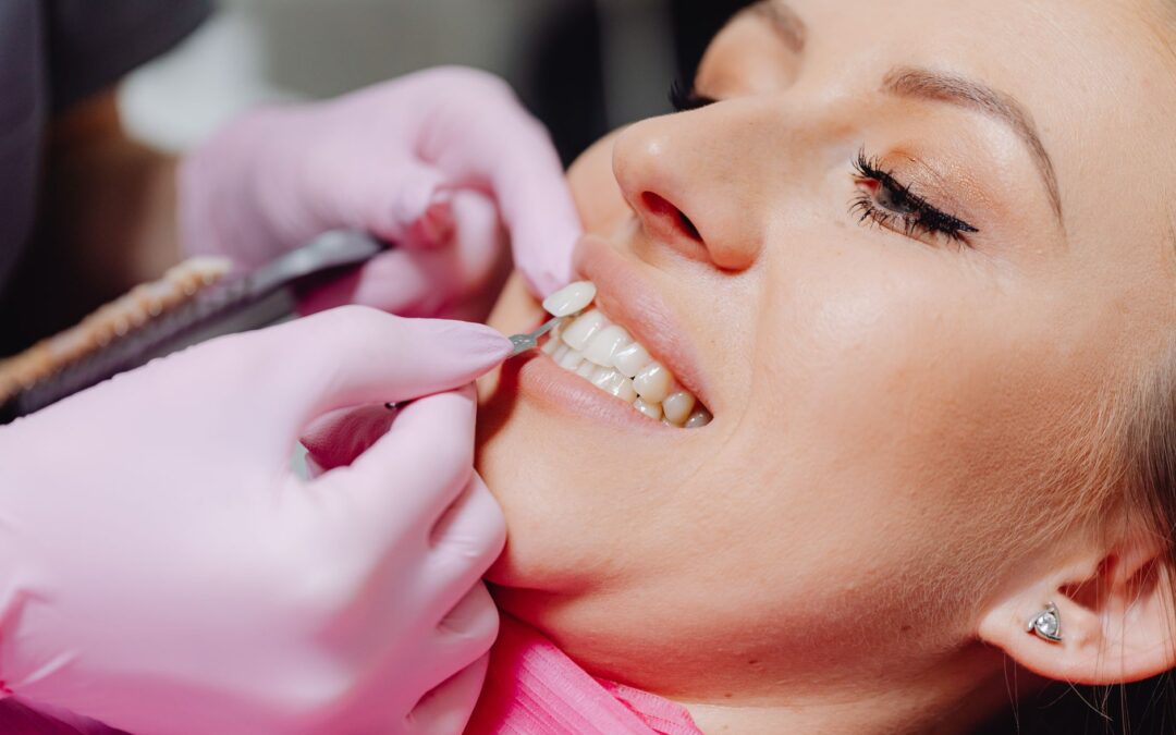 Prepless Veneers: The No-Drill Path to a New Smile — What You Should Know